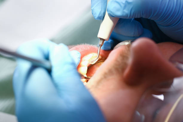 Best Knocked-Out Tooth (Avulsed Tooth) Treatment in Ardmore, PA
